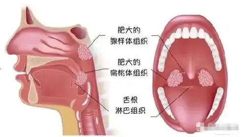 我院扁桃体腺样体手术预约火热开启啦
