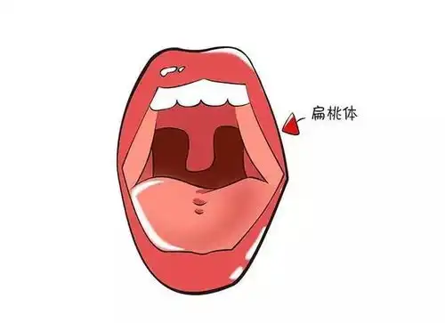 孩子扁桃体反复发炎肿大的危害有哪些