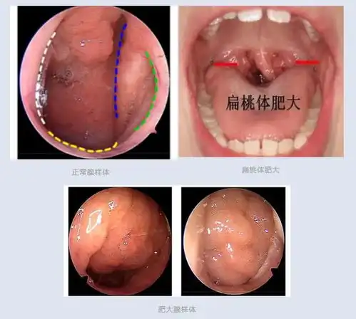 反复发炎,张口呼吸,腺样体扁桃体肥大,有必要切吗