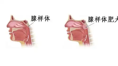 首大石萍发现孩子打呼噜怎么办解读儿童鼾症的秘密