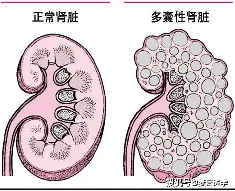 11岁小男孩肾脏功能受损,肾病呈年轻化趋势,这些身体异常要警惕
