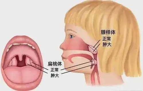 泰安市中心医院市立院区让孩子通畅呼吸健康睡眠