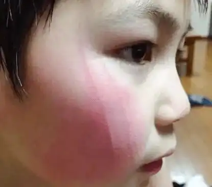 男孩吸猫成狂,猫咪反抗抓花他的脸,结果被暖哭了