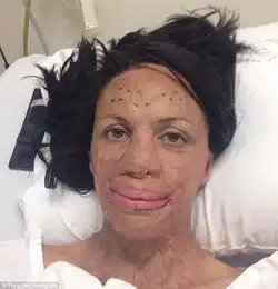 经历烧伤毁容截肢,她却嫁给全球最帅的男人,轰动了全世界