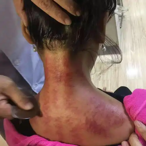 艾灸加刮痧,燃烧脂肪,跟大肚子拜拜