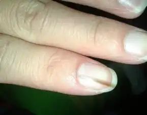 男朋友左手食指上长一条黑色竖线,是突然出现的,存在一年了