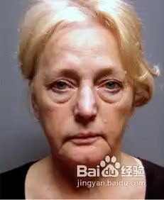 怎样去除眼袋之眼袋大可能是肾虚