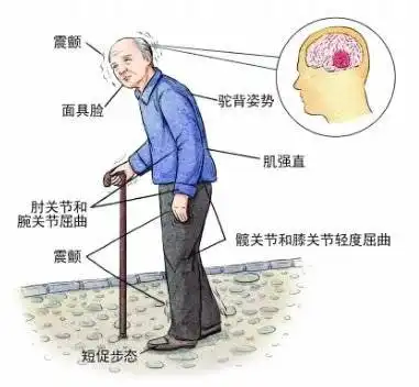 如何治手抖表情包帕金森