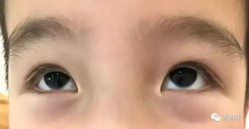 明明睡眠充足的孩子为何还会有黑眼圈是肾虚了吗真相会让家长吃惊