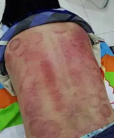 星河老师什么时候该刮痧,什么时候该拔罐,什么时候该按摩