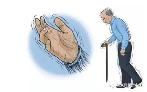 通过疏风平颤汤治疗好的手抖为什么之后要这么评价